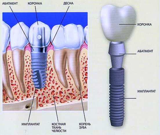 implant.jpg
